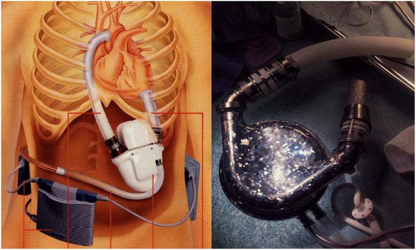 搏动式的心室辅助装置，缺点是体积大